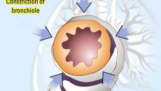 COPD Pathophysiology and Diagnosis [upl. by Nevuer623]