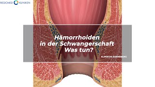 REGIOMED Kliniken Hämorrhoiden in der Schwangerschaft  Was tun [upl. by Erme]