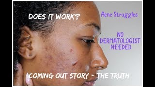 Acne Diaries  With Pics  1 Month Doxycycline  RetinA Tretinoin NO DERMATOLOGIST NEEDED [upl. by Latif907]