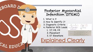 Posterior Myocardial Infarction On 12 Lead ECG  Diagnostic Criteria AND Posterior Leads V7 V8 V9 [upl. by Anerdna566]