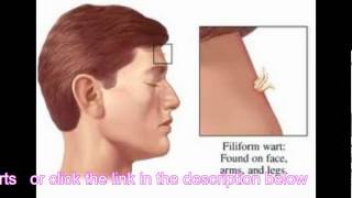 Filiform Warts  What Are the Characteristics of These Warts [upl. by Aikrahs566]