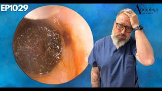 INSANE DEEP EAR WAX PLUG REMOVAL  EP1029 [upl. by Burley609]