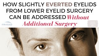 Ectropion and Lower Lid Retraction after Eyelid Surgery  Diagnosing Severity and Need for Revision [upl. by Ahsakal]