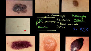 Melanocytic Lesions Part 1 [upl. by Aynodal]