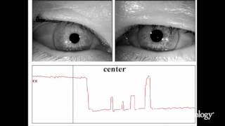 Nucleus prepositus hypoglossi lesions produce a unique ocular motor syndrome 12 [upl. by Dillon]