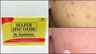 Dr Kaufmann Medicated Sulfur Soap Review [upl. by Eentruoc75]