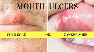 Mouth Ulcers Difference between CankerApthoussores and Coldherpes sores [upl. by Dnomyaw]