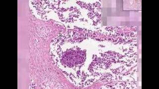 Histopathology Lung Small Cell Carcioma [upl. by Ainehta]