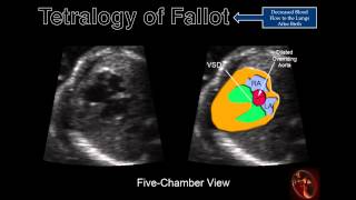 Fetal Echocardiography Tetralogy of Fallot [upl. by Ytomit]