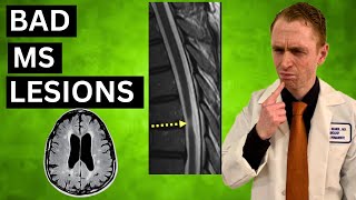 Bad MS MRI Lesions [upl. by Alamaj406]