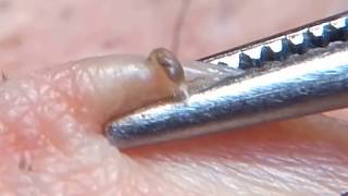 Very Black Blackheads removal with tweezers 3 [upl. by Jesh36]