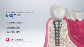 Geistlich 임플란트를 위한 선택 가이스트리히 바이오오스 잇몸뼈의 중요성 [upl. by Petie]