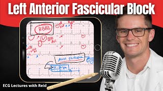 Left Anterior Fascicular Block LAFB EKG  ECG Lecture [upl. by Dyun]