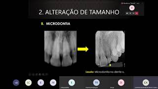 Anomalias dentárias [upl. by Mckenzie]