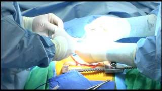 Coronary Bypass Surgery  Determining Your Risks [upl. by Yraht]