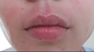 How to get rid of Perioral Dermatitis [upl. by Xenophon]