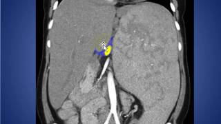 RADIOLOGY ROUNDS 036 SPLENOMEGALY [upl. by Htenaj]