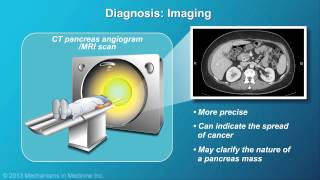 Pancreatic Cancer Pathophysiology Diagnosis and Staging [upl. by Alehcim]