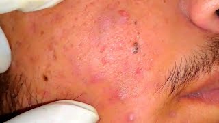 sac be spa blackheads elderly 2024  sac be spa old age blackheads 2024  sac be spa thuy 777 [upl. by Seta]