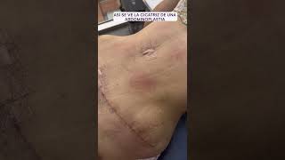 Cicatriz de una abdominoplastia  Dra lina Franco cirugiasplasticas [upl. by Catherine]