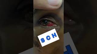 Subconjunctival Hemorrhage Part 4 Shorts SubconjunctivalHemorrhage [upl. by Ludovico661]