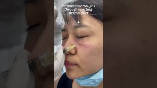 How to do tear trough filler with cannula [upl. by Egidio]