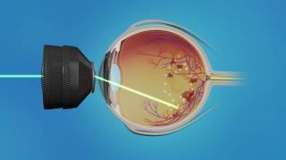 Medication Injection and Laser Surgery for Macular Edema [upl. by Scherman]