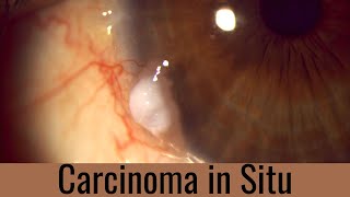 Cómo tratamos Carcinoma in Situ Conjuntival [upl. by Ybbil]