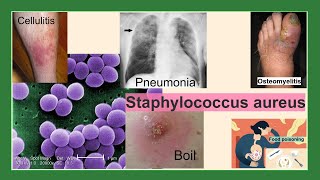 Staphylococcus aureus [upl. by Unders]