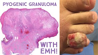 HUGE Pyogenic Granuloma lobular capillary hemangioma  extramedullary hematopoiesis Emory case 6 [upl. by Aenal]