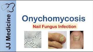 Onychomycosis  Nail Infection  Signs Symptoms Treatment [upl. by Nithsa34]