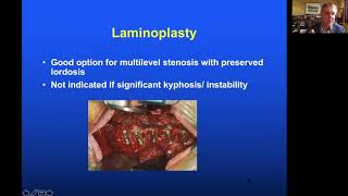 Management of Degenerative Cervical Myelopathy  Prof Michael Fehlings [upl. by Eph]