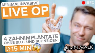 4 Implantate LIVEOP ohne Schneiden und ohne Blut Minimalinvasive ImplantatOP [upl. by Bernard]