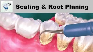 Treatment of periodontal disease  Scaling and root planing  Tartar © [upl. by Arracahs]