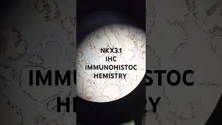 IMMUNOHISTOCHEMISTRY NKX31 HISTOPATHOLOGY histopathology pathology IMMUNOHISTOCHEMISTRY [upl. by Notsur]