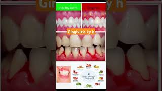 About gingivitis disease medicine medicaldegree drugeducation [upl. by Novej837]