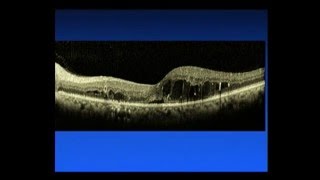 Diabetic Macular Edema  Saving Sight 2014 [upl. by Manton]