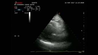 Echo Evaluation Of Cardiomyopathies Dr Rakesh Gupta [upl. by Amand]