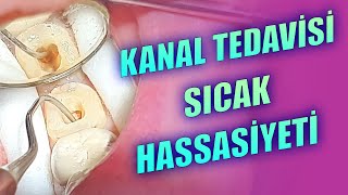 Kanal Tedavisi Sonrası Sıcak Ağrısı Olur mu [upl. by Dyal74]