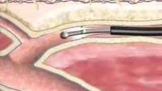 Varicose Veins Closure Procedure at BIDMC [upl. by Bowe]