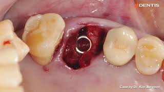 DENTIS Implant Upper posterior immediate implant placement with SQ fixture [upl. by Atteragram]