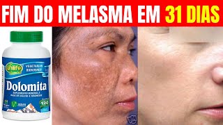 quotMáscara de porcelanaquot com dolomita é usar e eliminar o melasma Como curar o melasma naturalmente [upl. by Anitnauq]