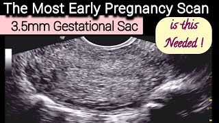 35mm Gestational Scan  The Most Early Pregnancy TVS Ultrasound [upl. by Sueddaht]