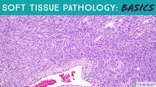 Basic Soft Tissue Pathology Cases Explained by a Sarcoma Pathologist [upl. by Deragon822]