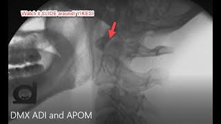 Upper Cervical Instability [upl. by Dymphia]