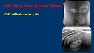 Intussusception Video [upl. by Oiruam207]