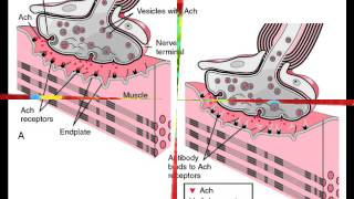 Myasthenia Gravis [upl. by Branscum121]