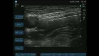 UltrasoundGuided Femoral Nerve Block [upl. by Shamma]