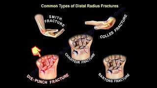 wrist fractures symptoms examination diagnosis and treatment [upl. by Nylisoj376]