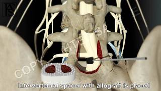 Lumbar Fusion of L5 S1 Posterior [upl. by Ewart169]